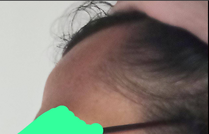 Lord Tetsu DHI hair transplant